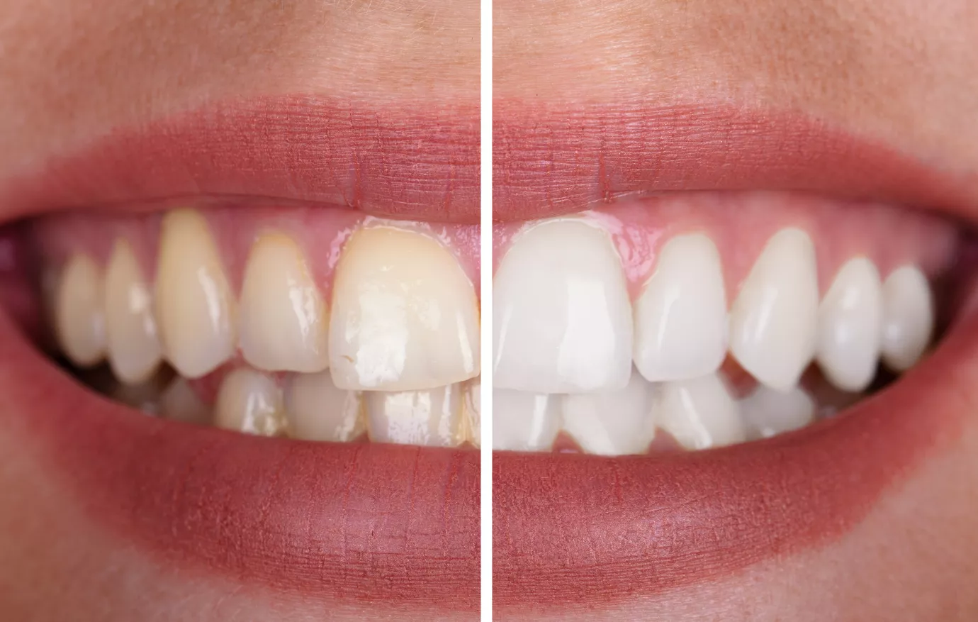 Teeth Whitening Treatments